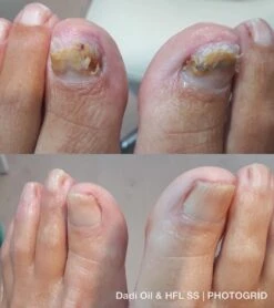 De Nummer 1 Tegen Schimmelnagels! - HFL - Laboratories - Solution Spray - 50ml + Dadi'Oil Nagelriem Olie - 3.75ml - Kalknagel Spray - Schimmelnagel Spray - Nagelriem Olie - Nagelverzorging 9 De Nummer 1 Tegen Schimmelnagels! - HFL - Laboratories - Solution Spray - 50ml + Dadi'Oil Nagelriem Olie - 3.75ml - Kalknagel Spray - Schimmelnagel Spray - Nagelriem Olie - Nagelverzorging -Winkel Voor Persoonlijke Verzorging 1065x1200 1