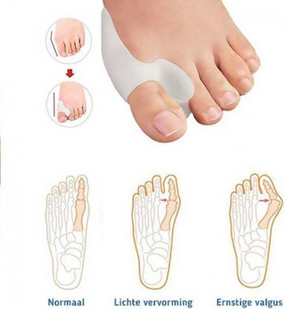 MYCARE+ Teencorrector - Wasbare Teencorrector - Gel-laag - 1 Paar - Pijn Verlichtend 8 MYCARE+ Teencorrector - Wasbare Teencorrector - Gel-laag - 1 Paar - Pijn Verlichtend - Afbeelding 6