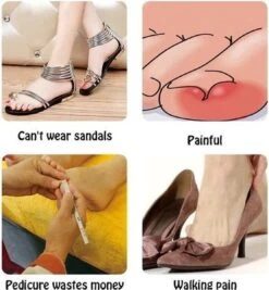 Merkloos Ingegroeide Teennagel Corrector -Winkel Voor Persoonlijke Verzorging 1111x1200 5