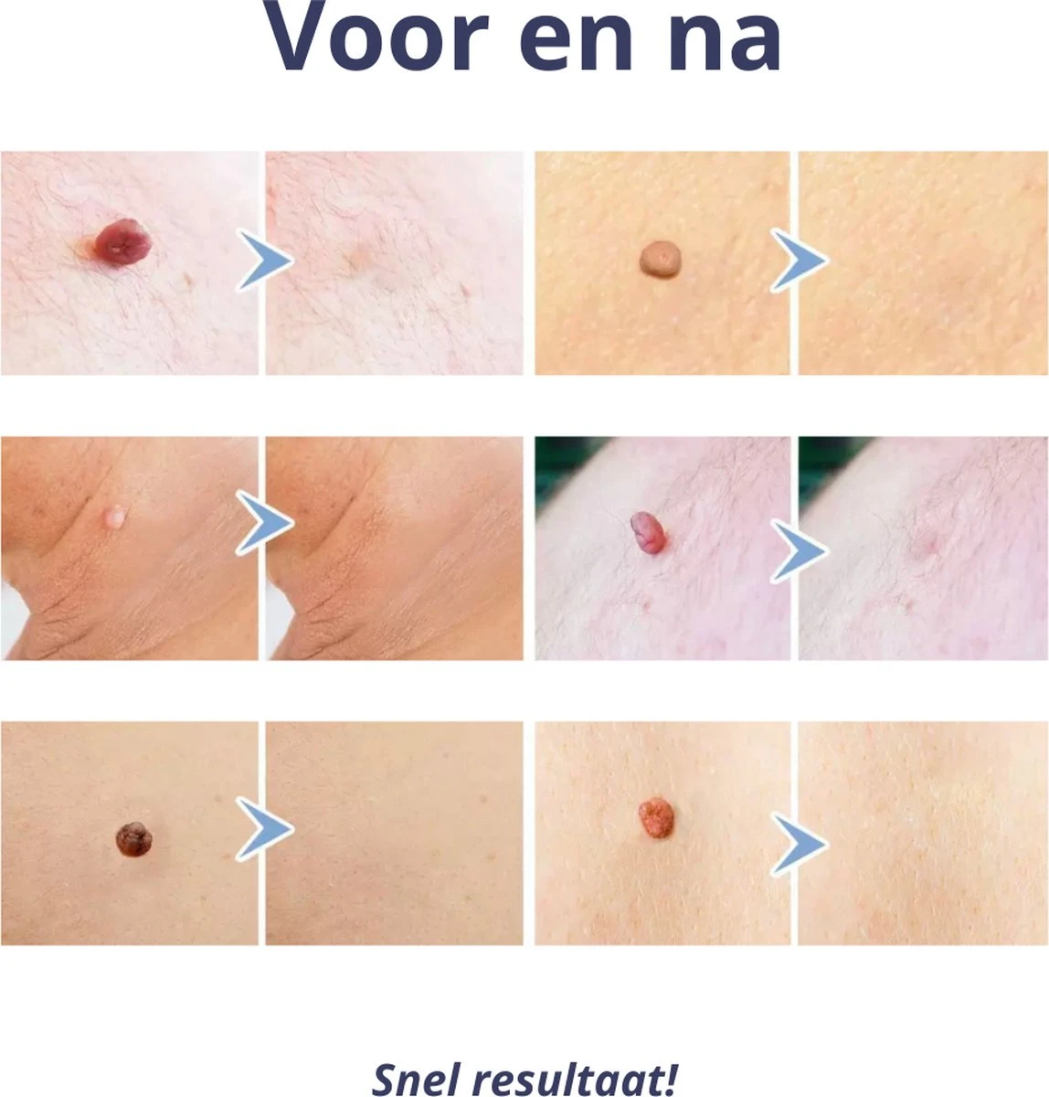 Steelwratjes Verwijderaar - Steelwratjes Verwijderen - Pijnloos En Snel - Wrattenverwijderaar - Steelwratten 6 Steelwratjes Verwijderaar - Steelwratjes Verwijderen - Pijnloos En Snel - Wrattenverwijderaar - Steelwratten - Afbeelding 4