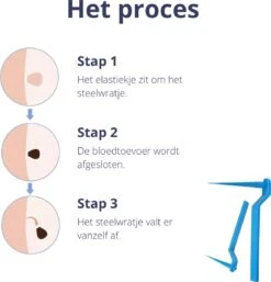 Steelwratjes Verwijderaar - Steelwratjes Verwijderen - Pijnloos En Snel - Wrattenverwijderaar - Steelwratten 10 Steelwratjes Verwijderaar - Steelwratjes Verwijderen - Pijnloos En Snel - Wrattenverwijderaar - Steelwratten -Winkel Voor Persoonlijke Verzorging 1154x1200 2