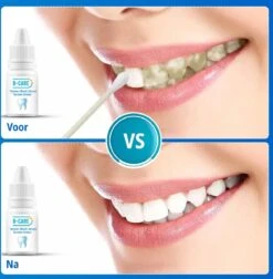 B-care Tanden Bleker – Wittere Tanden – Teeth Whitening Strips – Professioneel Resultaat - Tandsteen Verwijderaar - Zonder Peroxide - Tandenbleekset - Tanden Bleken -Winkel Voor Persoonlijke Verzorging 1177x1200 4