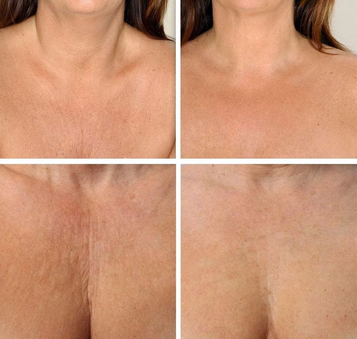 Simia™ Anti Rimpel Beauty Pads - Decolleté Large T Shape Set (2 Stuks) - Herbruikbaar Anti Aging Siliconen Pad Tegen Lijntjes En Slaaprimpels 6 Simia™ Anti Rimpel Beauty Pads - Decolleté Large T Shape Set (2 Stuks) - Herbruikbaar Anti Aging Siliconen Pad Tegen Lijntjes En Slaaprimpels - Afbeelding 4