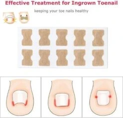 Merkloos Ingegroeide Teennagel Corrector -Winkel Voor Persoonlijke Verzorging 1200x1146 7