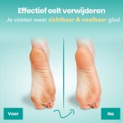 FreshDragon Elektrische Eelt Verwijderaar - Voetvijl - Inclusief 3 Rollers - Oplaadbaar -Winkel Voor Persoonlijke Verzorging 1200x1200 1934