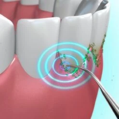 Toppers Van TV - Sonic Tandsteenverwijderaar - Tandplakverwijderaar -Winkel Voor Persoonlijke Verzorging 1200x1200 437