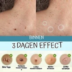 Skini™ - Moedervlekken & Wratten & Skin Tags Verwijderaar | Moedervlekken Verwijderaar | Wratten Verwijderaar | Moedervlekken Verwijderen | Wratten Verwijderen | Fibroom Verwijderen | Skin Tag Verwijderen | Steelwratjes Verwijderen -Winkel Voor Persoonlijke Verzorging 1200x1200 980