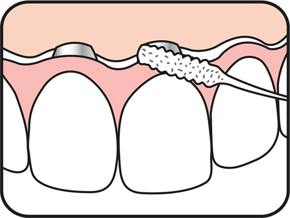 Tepe Floss Bridge & Implant 30 St 6 Tepe Floss Bridge & Implant 30 St - Afbeelding 4