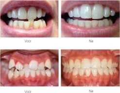 Edoir Rechte Tanden Beugel - Retainer Voor Rechte Tanden - Rechte Tanden Bitje 13 Edoir Rechte Tanden Beugel - Retainer Voor Rechte Tanden - Rechte Tanden Bitje -Winkel Voor Persoonlijke Verzorging 1200x929