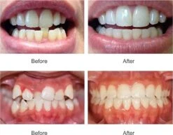 SAMA Direct™ Rechte Tanden Zonder Beugel - Orthodontische Bitjes - Rechte Tanden Bitje - Beugel - Knarsbitje - Nachtbeugel - Knarsen Bitje - Rechte Tanden - Witte Tanden -Winkel Voor Persoonlijke Verzorging 1200x938 1