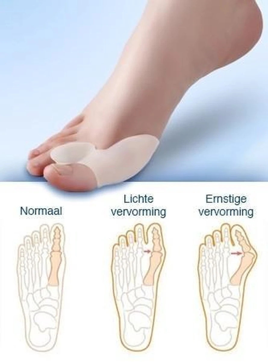 MYCARE+ Teencorrector - Wasbare Teencorrector - Gel-laag - 1 Paar - Pijn Verlichtend 6 MYCARE+ Teencorrector - Wasbare Teencorrector - Gel-laag - 1 Paar - Pijn Verlichtend - Afbeelding 4