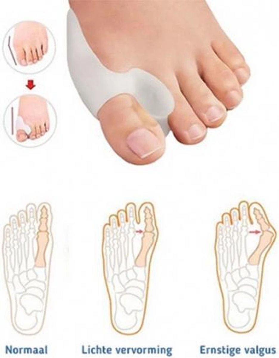 MYCARE+ Teencorrector - Wasbare Teencorrector - Gel-laag - 1 Paar - Pijn Verlichtend 7 MYCARE+ Teencorrector - Wasbare Teencorrector - Gel-laag - 1 Paar - Pijn Verlichtend - Afbeelding 5